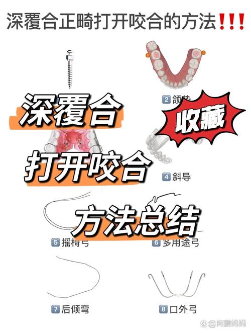 正畸打开深覆合有哪些常用方法?不同方法的适应症和治疗效果如何评估?-图1 正畸打开深覆合有哪些常用方法?不同方法的适应症和治疗效果如何评估?-图1
