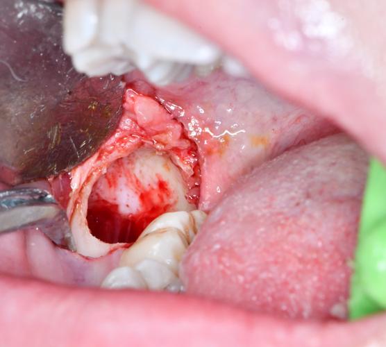 舌向阻生牙拔除方法有哪些？不同拔除技术的适应症、操作难点及临床效果如何评估？-图2