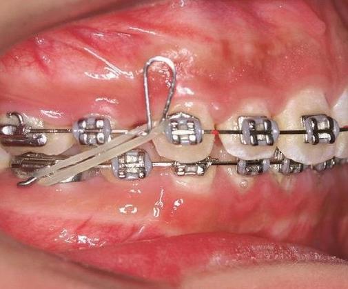 正畸治疗中停止曲的阻止作用具体指什么？其实现机制与临床应用效果如何？-图2