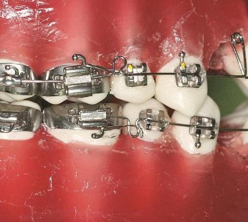 正畸治疗中停止曲的阻止作用具体指什么？其实现机制与临床应用效果如何？-图1