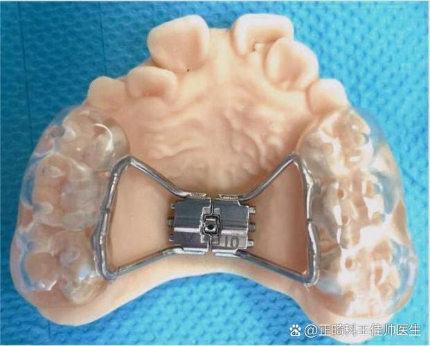 牙齿扩张器的正确使用方法是什么?新手必看的操作步骤、时长控制及注意事项有哪些?-图1 牙齿扩张器的正确使用方法是什么?新手必看的操作步骤、时长控制及注意事项有哪些?-图1