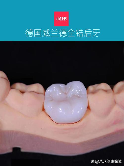 德国种牙品牌怎么选？不同技术、口碑和性价比的牌子哪个更适合你的口腔需求？-图2