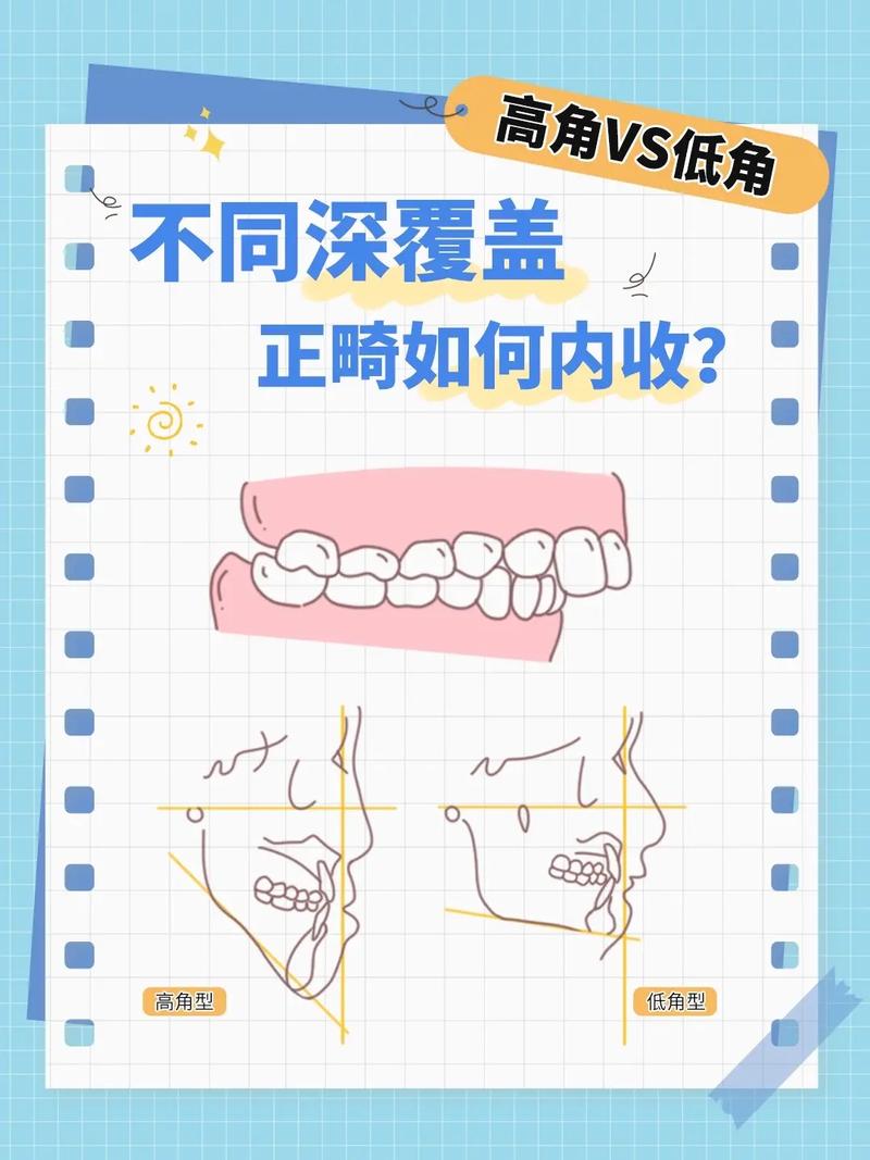 牙性深覆盖矫正方法有哪些？不同矫正方式的优缺点和适用人群是怎样的？-图1