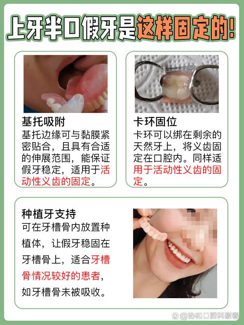 牙齿固定有几种常见方法？图解不同固定技术的适用场景与操作步骤是什么？-图3