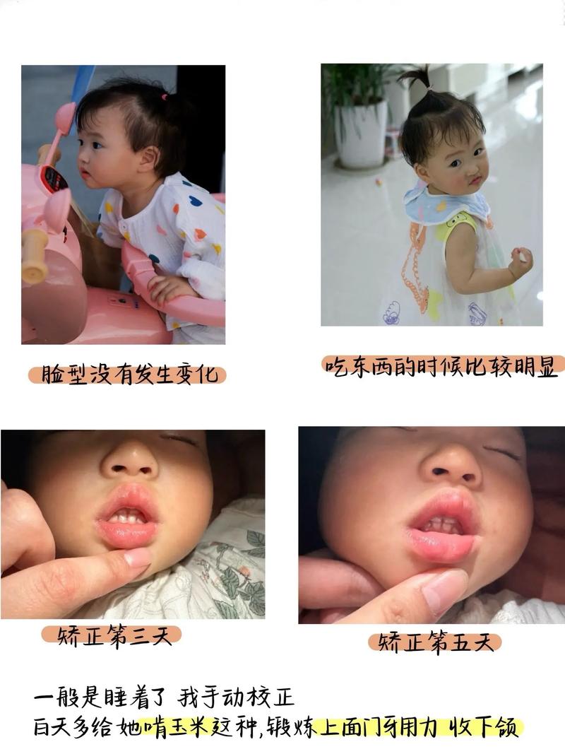 儿童反咬合(地包天)矫正有哪些常用方法?最佳干预年龄是几岁?如何选择适合的矫正方式?-图2 儿童反咬合(地包天)矫正有哪些常用方法?最佳干预年龄是几岁?如何选择适合的矫正方式?-图2