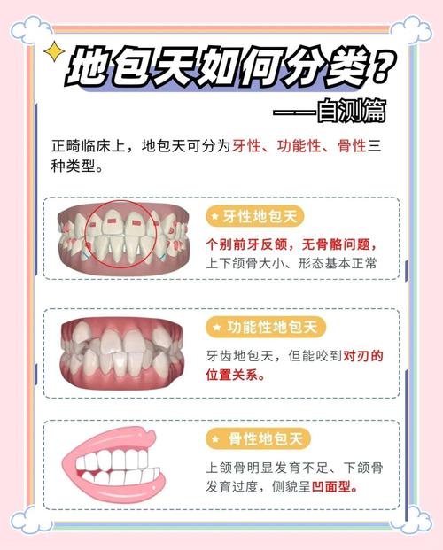 针对牙性地包天问题，临床上常见的矫正方法有哪些？不同方法各自的适用人群、矫正周期及效果如何？-图2