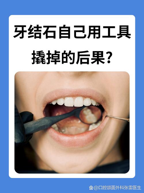 清除牙结石的好方法有哪些？不同人群如何选择安全有效的方案，日常护理能替代专业洗牙吗？-图2