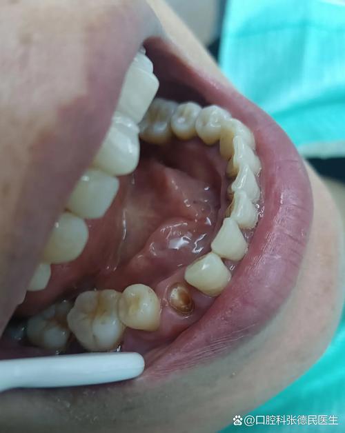 牙根缺失后还能不能种牙？没有牙根的情况下种植牙可行吗？需要满足哪些前提条件才能成功种牙？-图2