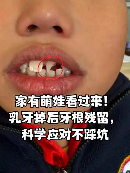 牙根完全缺失后，种植牙还有可能吗？需要满足哪些条件才能成功种牙？-图3