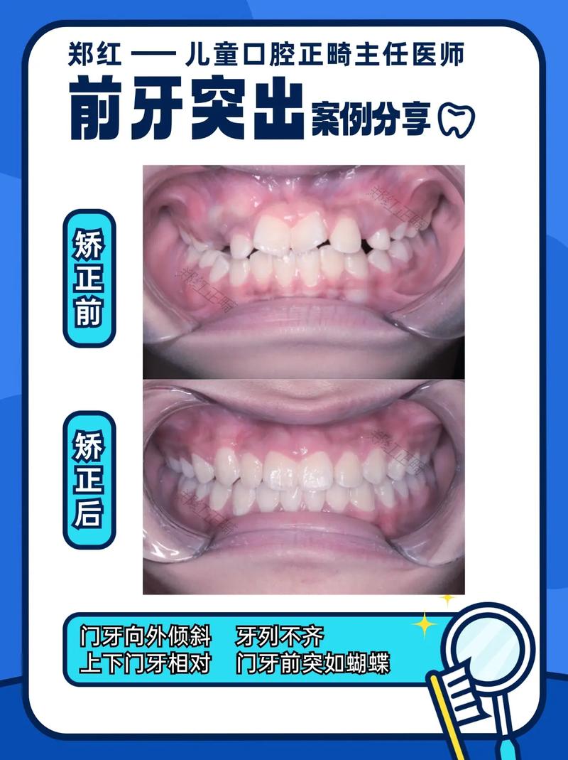 青少年龅牙矫正有哪些常见方法？不同矫正方式的适用年龄、效果及注意事项分别是什么？-图1