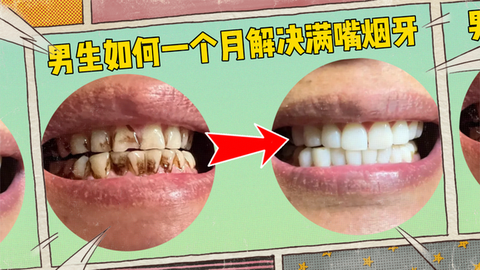牙齿上的顽固烟渍如何有效去除？有哪些安全又实用的方法能快速恢复牙齿洁白？-图2