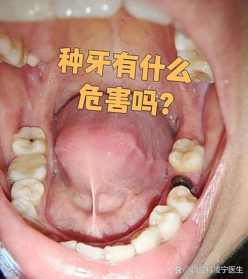 牙槽骨突出到底能不能种牙?会不会影响种植效果?需要先做哪些处理才能顺利种牙?-图2 牙槽骨突出到底能不能种牙?会不会影响种植效果?需要先做哪些处理才能顺利种牙?-图2
