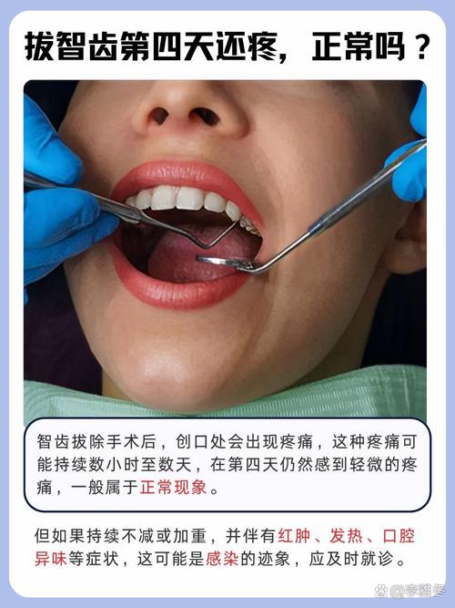 正畸矫正结束后拔智齿的最佳时间是什么时候？会影响矫正后的牙齿稳定性和整体效果吗？-图2