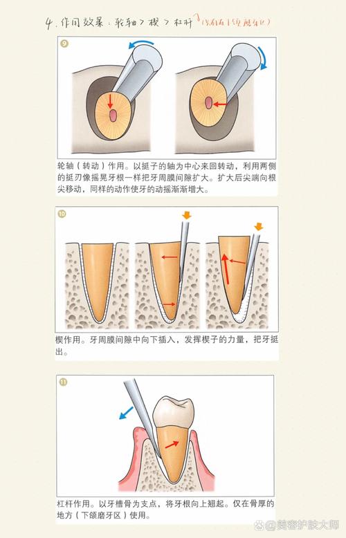 在家拔牙真的可行吗？有哪些潜在风险和正确操作步骤？医生为何不建议自行拔牙？-图2