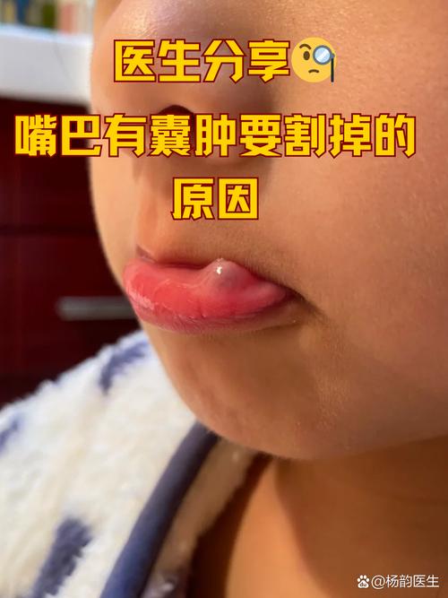 口腔囊肿治疗方法有哪些？不同类型囊肿如何选择最佳方案？术后复发率高吗？-图1