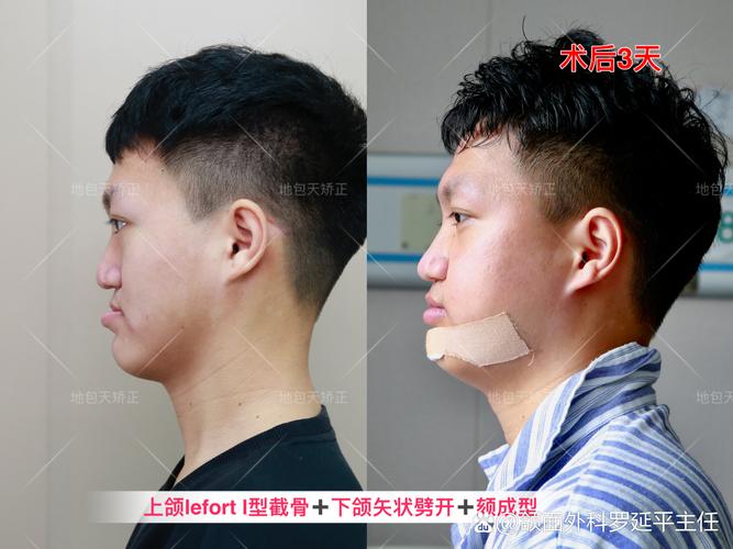 骨性地包天若仅依赖正畸矫正，效果真能达到预期吗？是否会对骨骼结构造成不良影响或增加复发风险？-图1