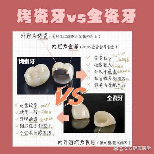 种牙和烤瓷牙究竟有何本质区别？适用人群、修复原理及长期效果差异全解析-图3