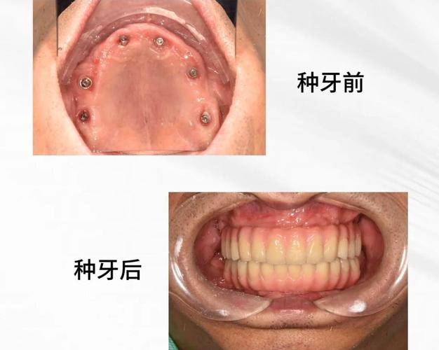 全口种植牙到底要种几颗?牙齿缺失数量、牙槽骨条件如何影响种植数量,All-on-4等不同技术方案有何区别?-图2 全口种植牙到底要种几颗?牙齿缺失数量、牙槽骨条件如何影响种植数量,All-on-4等不同技术方案有何区别?-图2