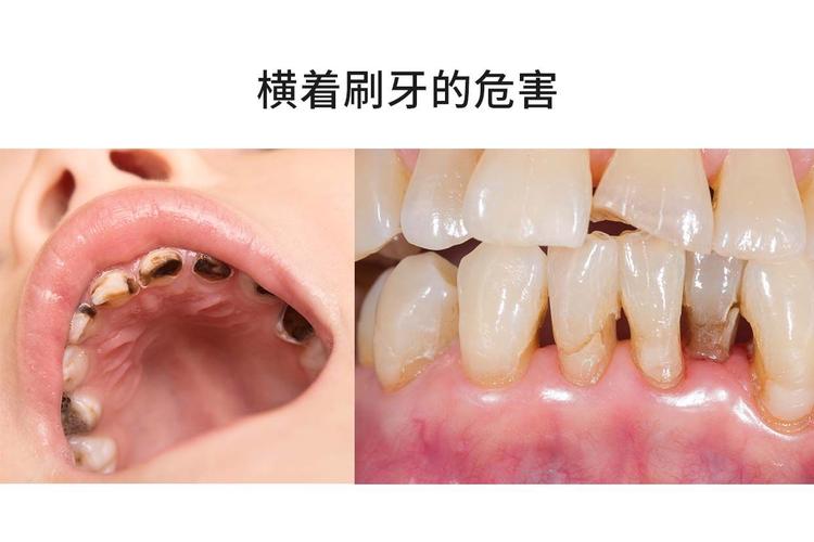 刷牙方法不对竟埋下这么多健康隐患？这些错误习惯如何悄悄损伤牙齿与牙龈？-图2