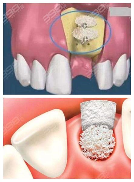 种牙植骨后骨粉为什么会漏出?这种情况会对种植牙效果产生哪些影响?又该如何正确处理和预防?-图1 种牙植骨后骨粉为什么会漏出?这种情况会对种植牙效果产生哪些影响?又该如何正确处理和预防?-图1