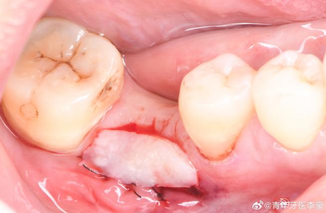 种牙植骨后骨粉为什么会漏出?这种情况会对种植牙效果产生哪些影响?又该如何正确处理和预防?-图2 种牙植骨后骨粉为什么会漏出?这种情况会对种植牙效果产生哪些影响?又该如何正确处理和预防?-图2