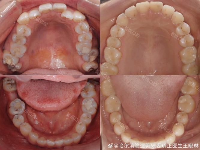 口腔正畸真的能把歪长的智齿掰正吗？原理、效果及适用条件大揭秘-图3