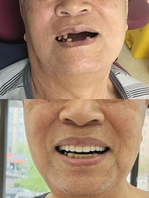 70岁老人能否种牙成功?年龄是否为绝对限制,身体状况和术后恢复需关注哪些关键问题?-图1 70岁老人能否种牙成功?年龄是否为绝对限制,身体状况和术后恢复需关注哪些关键问题?-图1