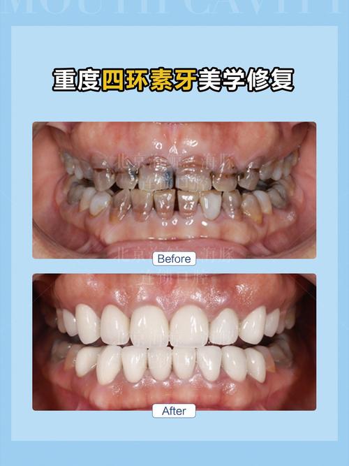 四环素牙齿美白方法有哪些？不同方法的效果如何，是否存在风险，又该如何科学选择？-图1