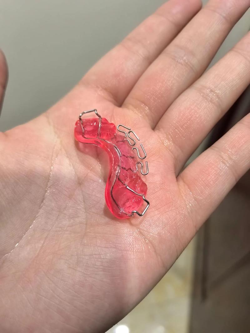 反颌矫正器的制作方法有哪些技术要点？不同反颌类型（如骨性、牙性）的定制方案有何差异？材料选择如何影响矫正效果与佩戴舒适度？-图3