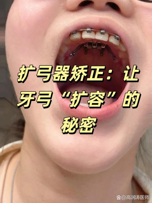 牙齿扩弓器使用方法详解,从佩戴步骤到日常护理,这些关键操作你都做对了吗?-图2 牙齿扩弓器使用方法详解,从佩戴步骤到日常护理,这些关键操作你都做对了吗?-图2