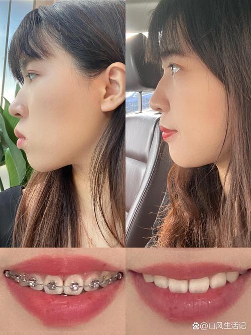 正畸牙齿矫正真的能让鼻梁变高吗?背后的原因、真实效果及科学依据是什么?-图1 正畸牙齿矫正真的能让鼻梁变高吗?背后的原因、真实效果及科学依据是什么?-图1