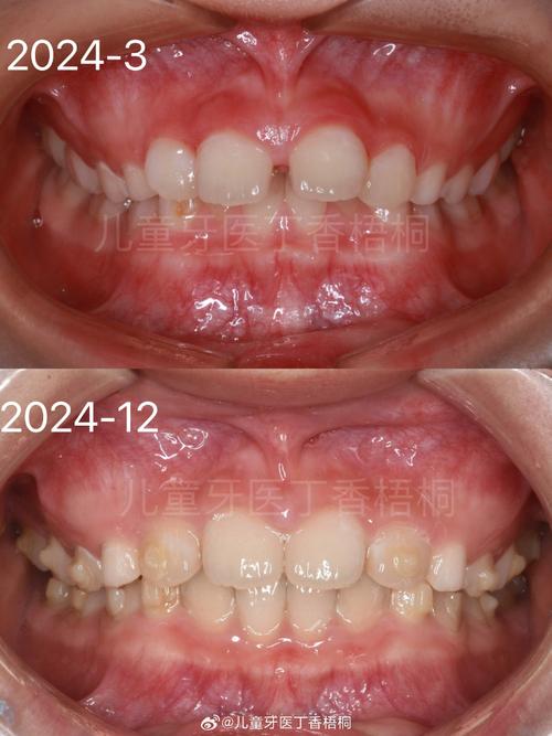 儿童正畸后牙齿变色是什么原因导致的？会影响牙齿健康吗？该如何有效处理和预防？-图2