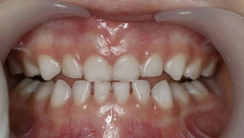 儿童正畸后牙齿变色是什么原因导致的？会影响牙齿健康吗？该如何有效处理和预防？-图1