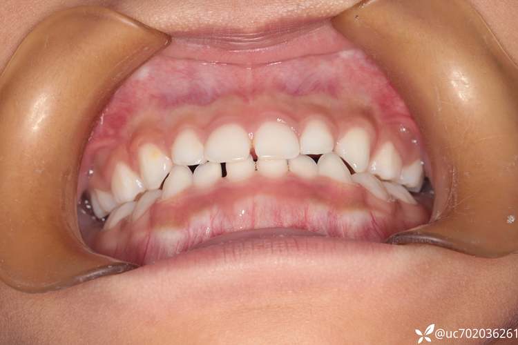 儿童正畸后牙齿变色是什么原因导致的？会影响牙齿健康吗？该如何有效处理和预防？-图3