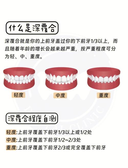 成人深覆合矫正方法有哪些?不同矫正方式(如传统托槽、隐形矫正、正畸正颌联合)的效果、周期及适应症该如何科学选择?-图1 成人深覆合矫正方法有哪些?不同矫正方式(如传统托槽、隐形矫正、正畸正颌联合)的效果、周期及适应症该如何科学选择?-图1