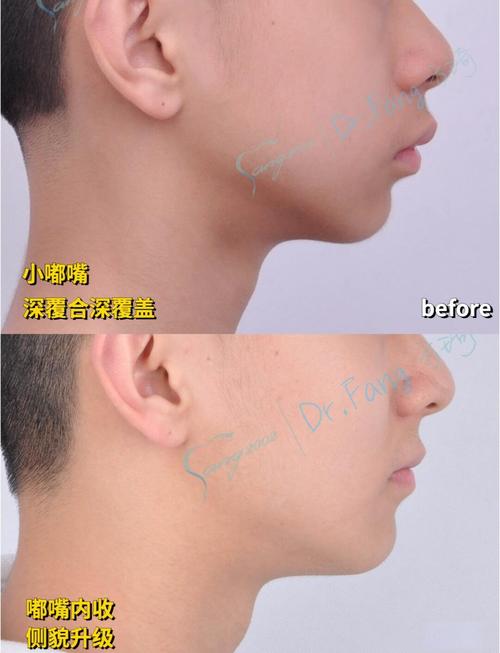 成人深覆合矫正方法有哪些？不同矫正方式（如传统托槽、隐形矫正、正畸正颌联合）的效果、周期及适应症该如何科学选择？-图2