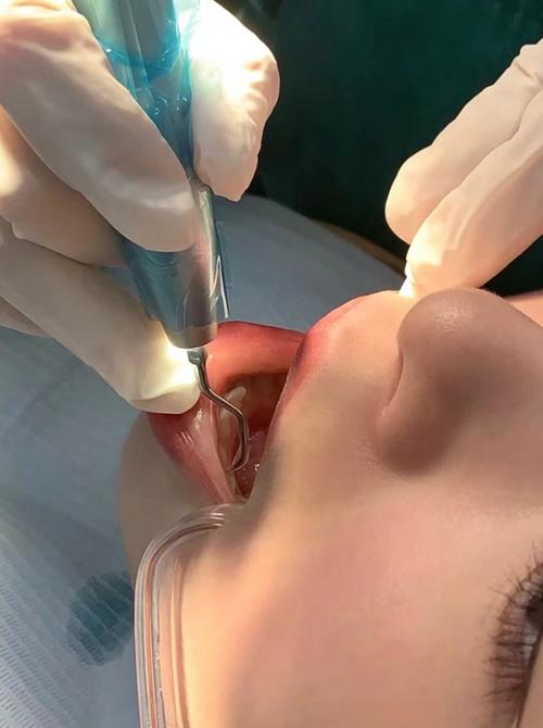 口腔科手机清洗的关键步骤有哪些？不同型号手机的清洗方法有何差异？-图3