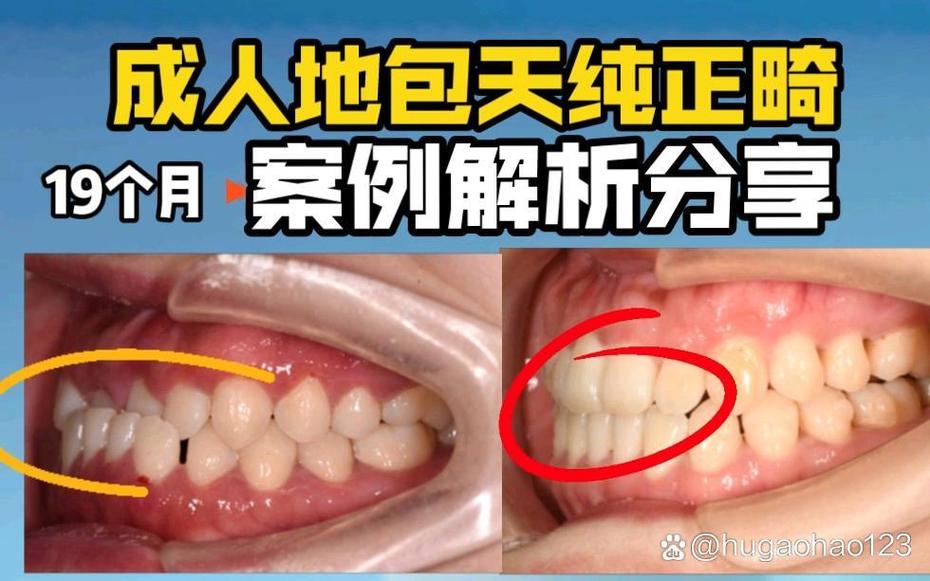 成年地包天矫正方法有哪些？不同矫正方式的优缺点是什么？矫正周期和效果会因人而异吗？-图3