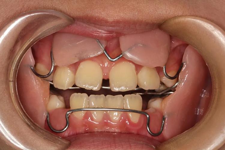 成年地包天矫正方法有哪些？不同矫正方式的优缺点是什么？矫正周期和效果会因人而异吗？-图2