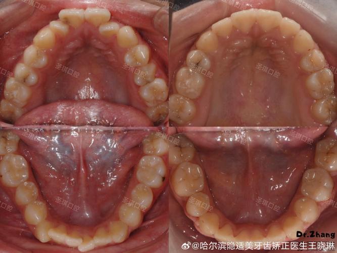 正畸治疗中为何需拔除下颌4颗牙齿？病例展示揭示哪些适应症与关键考量？-图3