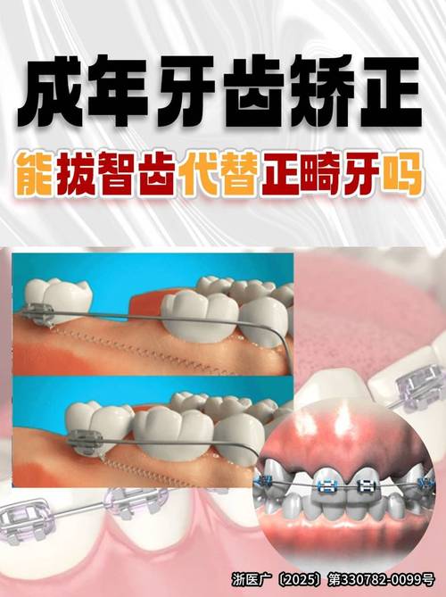 拔智齿综合科还是正畸-图1