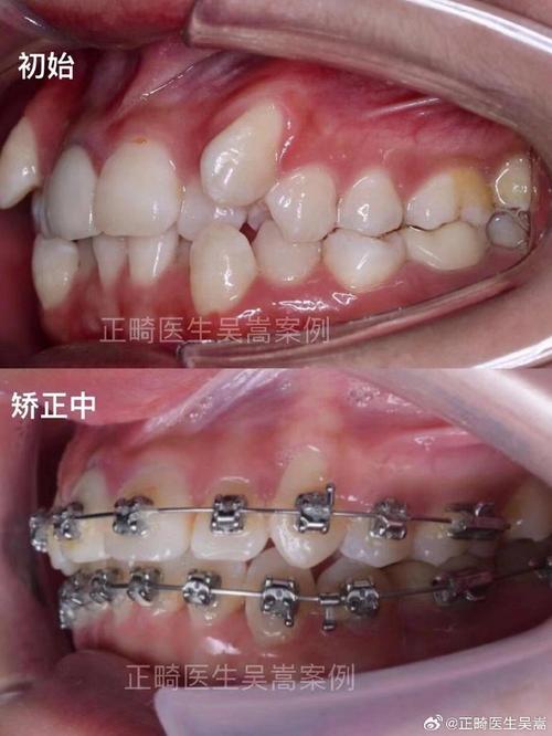 南京做牙齿正畸该挂哪个科室？是口腔科还是专门的正畸科？南京有哪些医院擅长牙齿正畸治疗？-图3