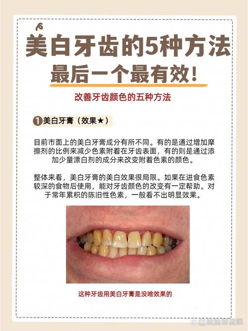 生活中牙齿美白方法五花八门，哪些才是真正安全有效的？如何避免美白过程中的牙齿损伤？-图3