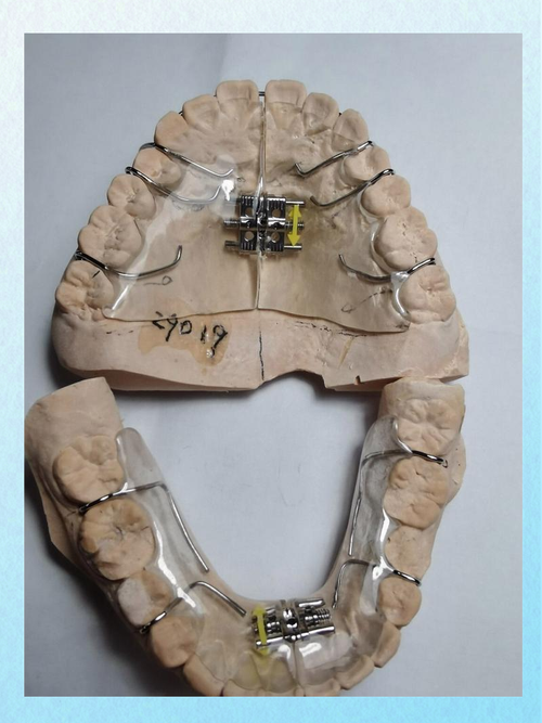 口腔正畸中常用的矫治器械有哪些？不同类型的托槽、弓丝等器械如何协同作用实现牙齿移动？-图3
