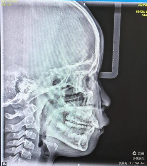 正畸诊断中X线检查为何不可或缺？不同类型X线片如何辅助分析牙齿、颌骨及咬合关系的异常？-图1