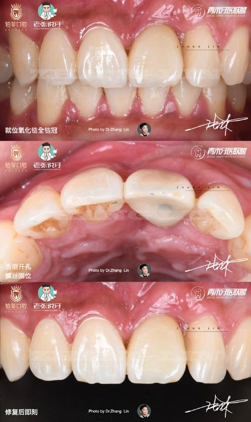 牙槽骨骨吸收会影响种牙吗?骨吸收后还能成功种牙吗?需要做哪些骨修复准备才能种牙?-图1 牙槽骨骨吸收会影响种牙吗?骨吸收后还能成功种牙吗?需要做哪些骨修复准备才能种牙?-图1