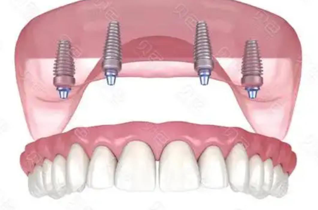 牙槽骨骨吸收会影响种牙吗？骨吸收后还能成功种牙吗？需要做哪些骨修复准备才能种牙？-图3