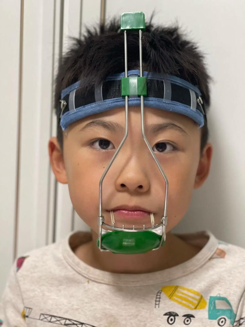 成人地包天矫正方法有哪些?不同矫正方式的效果、风险和适用人群有何差异?-图2 成人地包天矫正方法有哪些?不同矫正方式的效果、风险和适用人群有何差异?-图2