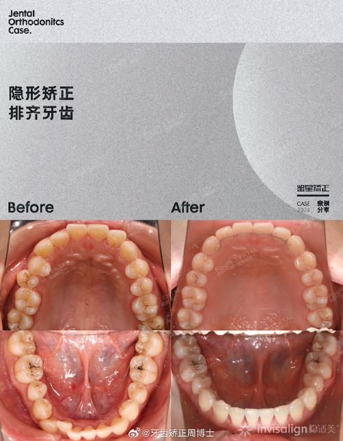 隐形正畸如何精准重建颌面?对不同颌面畸形的效果差异与适用人群有哪些?-图3 隐形正畸如何精准重建颌面?对不同颌面畸形的效果差异与适用人群有哪些?-图3