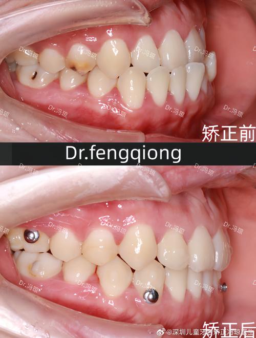 隐形正畸如何精准重建颌面？对不同颌面畸形的效果差异与适用人群有哪些？-图2